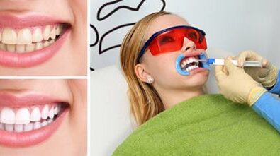 Whitenex Teeth Whitening